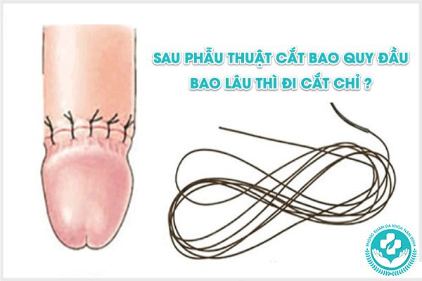 cắt bao quy đầu có cần nằm viện không