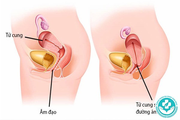 cục thịt lồi ra ở cửa mình khi mang thai