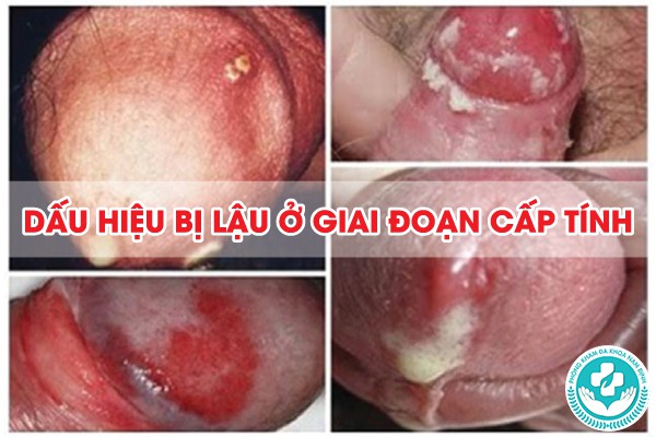 dấu hiệu bị lậu