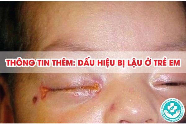 dấu hiệu bị lậu