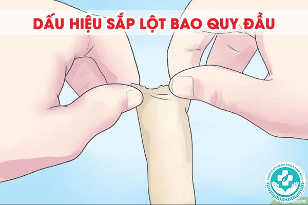 dấu hiệu sắp lột bao quy đầu