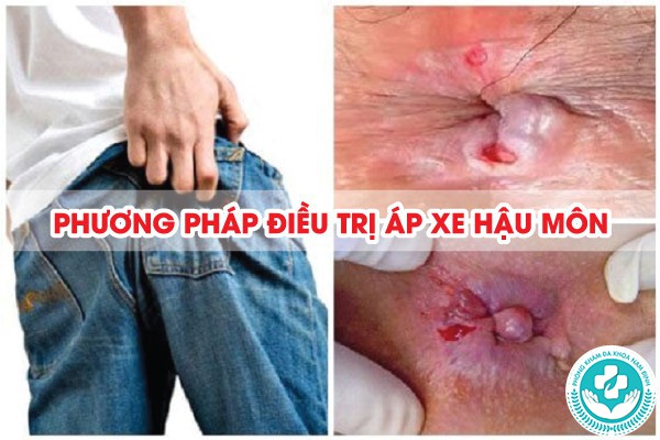 áp xe hậu môn