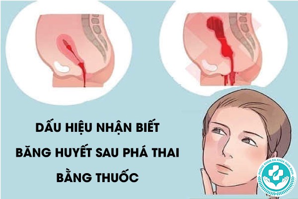 băng huyết sau phá thai bằng thuốc