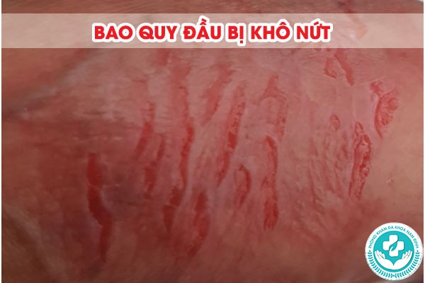 Bao quy đầu bị khô nứt bôi thuốc gì