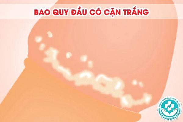bao quy đầu có cặn trắng