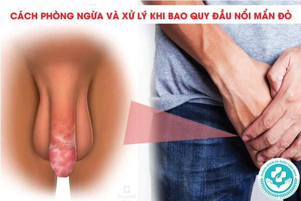 bao quy đầu nổi mẩn đỏ