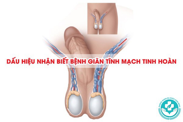 bệnh giãn tĩnh mạch tinh hoàn