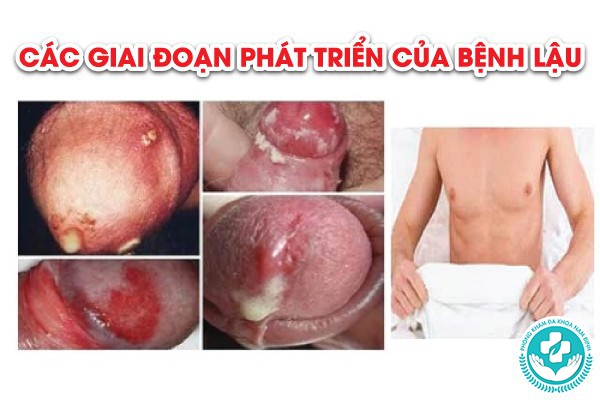 bệnh lậu có mấy giai đoạn