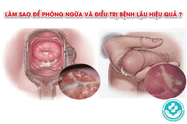 bệnh lậu có mấy giai đoạn