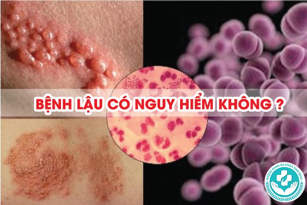 bệnh lậu có nguy hiểm không