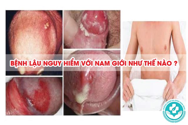 bệnh lậu có nguy hiểm không