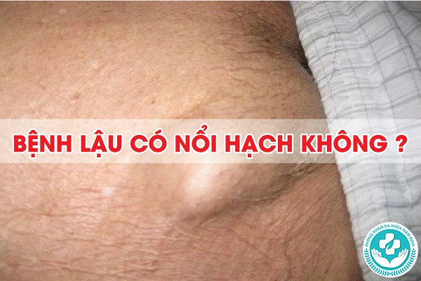 bệnh lậu có nổi hạch không