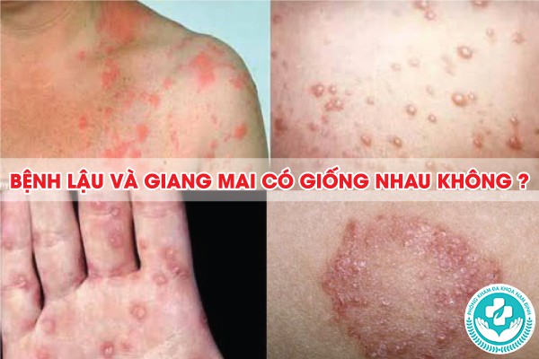 bệnh lậu và giang mai có giống nhau không