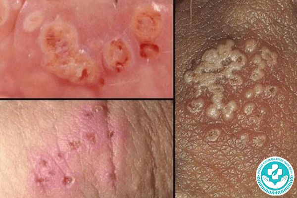 bệnh lây qua đường tình dục ở nữ