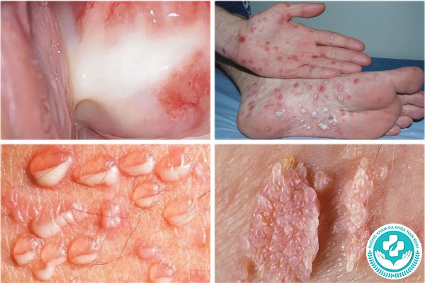 bệnh lây truyền qua đường tình dục gồm những bệnh nào
