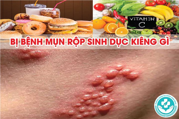 bệnh mụn rộp sinh dục kiêng gì