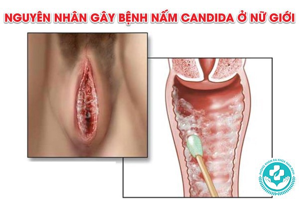 bệnh nấm candida