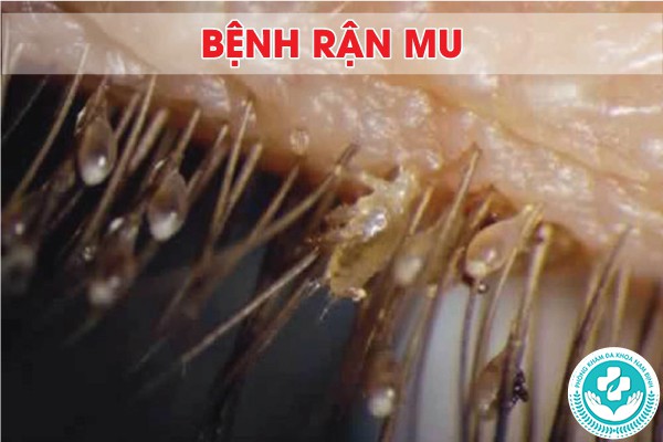bệnh nhiễm trùng vùng sinh dục ở nam bệnh nhiễm trùng vùng sinh dục ở nam