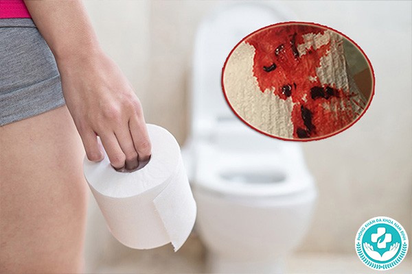 bệnh polyp hậu môn có nguy hiểm không