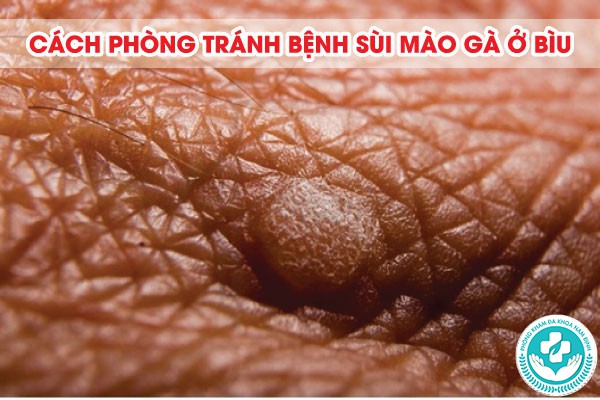 sùi mào gà ở bìu