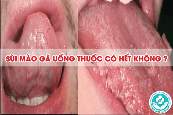 bệnh sùi mào gà uống thuốc có hết không