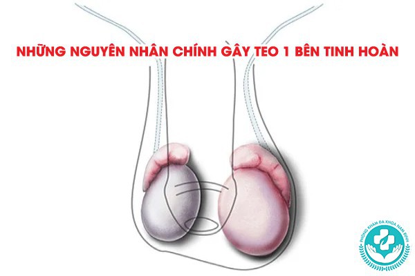 bệnh teo 1 bên tinh hoàn