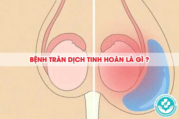 bệnh tràn dịch tinh hoàn là gì