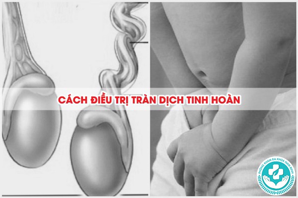 bệnh tràn dịch tinh hoàn là gì