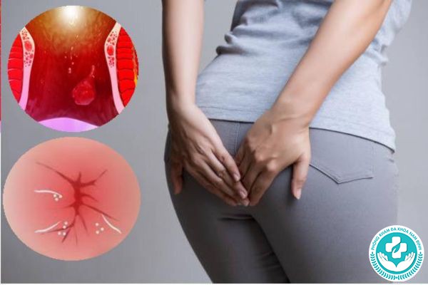 bệnh trĩ có gây táo bón không