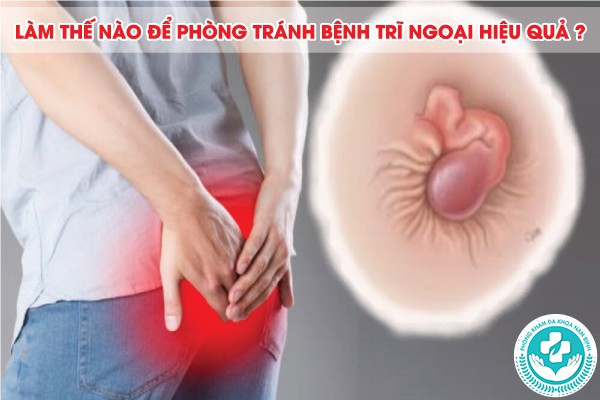 bệnh trĩ ngoại giai đoạn đầu