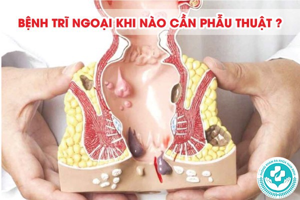 bệnh trĩ ngoại khi nào cần phẫu thuật