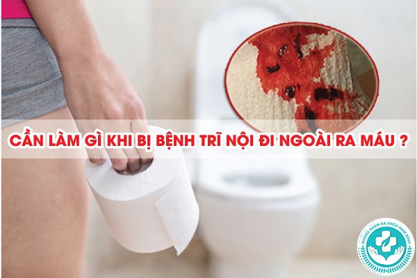 bệnh trĩ nội đi ngoài ra máu