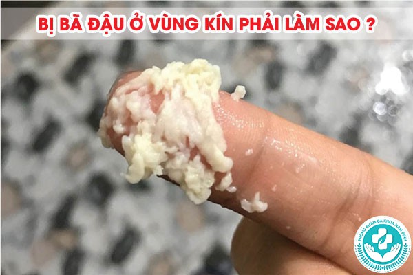 bị bã đậu ở vùng kín