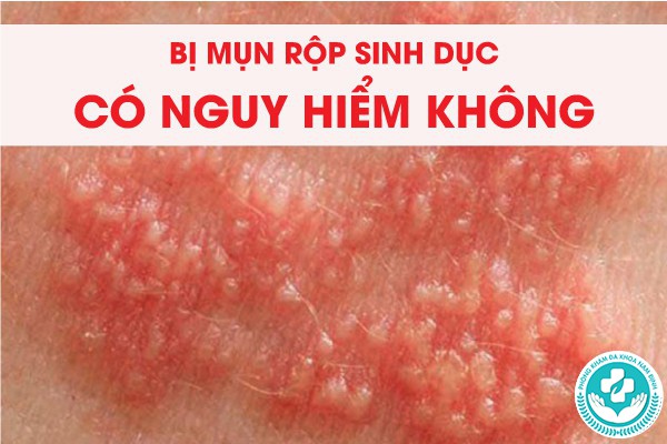 bị mụn rộp sinh dục có nguy hiểm không