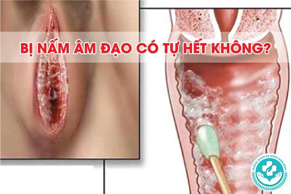 bị nấm âm đạo có tự hết không