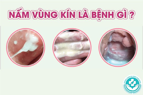 bị nấm vùng kín có lây không
