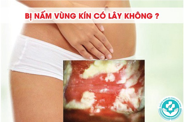 bị nấm vùng kín có lây không