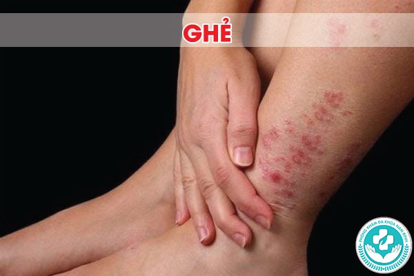 bị ngứa ở vùng kín nữ giới là bệnh gì