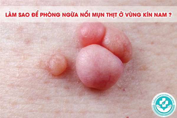 bị nổi mụn thịt ở vùng kín nam