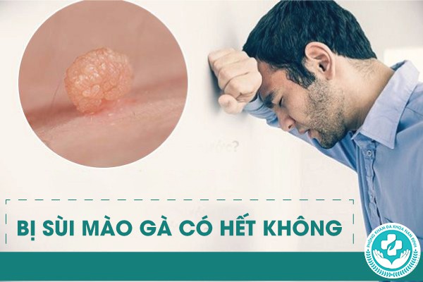 bị sùi mào gà có hết không