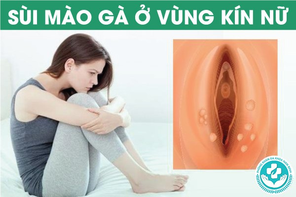 bị sùi mào gà ở vùng kín