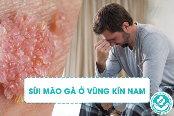 bị sùi mào gà ở vùng kín