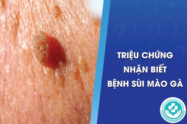 bị sùi mào gà ở vùng kín có ngứa không
