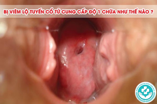 bị viêm lộ tuyến cổ tử cung cấp độ 1 bị viêm lộ tuyến cổ tử cung cấp độ 1