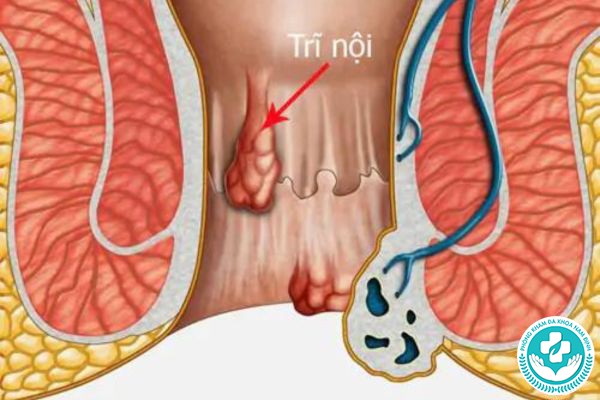 biến chứng bệnh trĩ nội