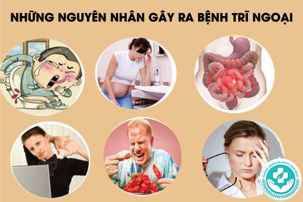 biểu hiện của bệnh trĩ ngoại