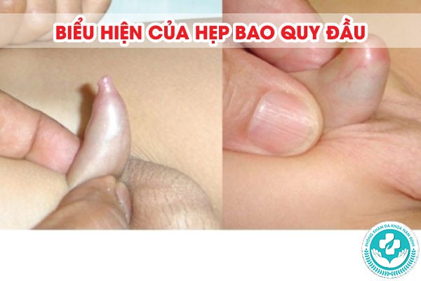 biểu hiện của hẹp bao quy đầu