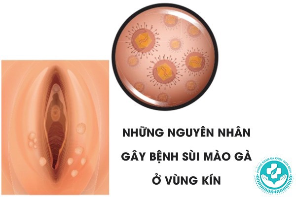 biểu hiện của sùi mào gà ở vùng kín