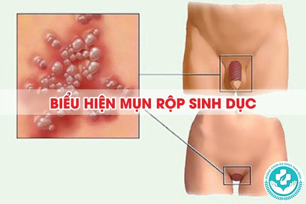 biểu hiện mụn rộp sinh dục