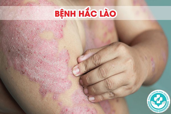 Các loại bệnh nấm ngoài da